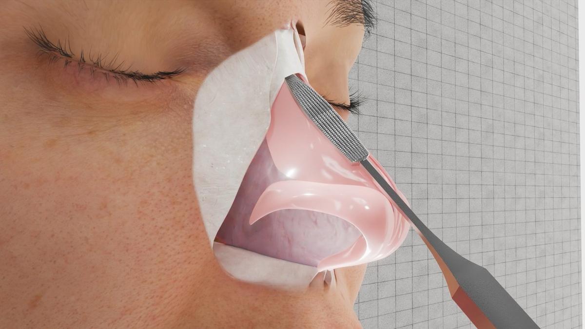 Dorsal Hump (Hump Reduction / Dorsal Refinement)