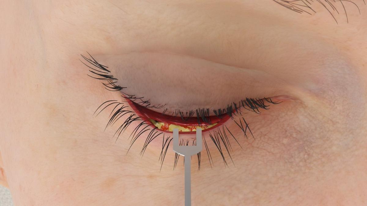 Tear Trough Implant – Transconjunctival Approach (Internal Incision)