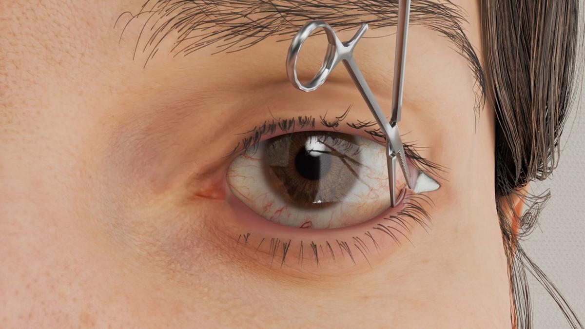 Ectropion Repair - Lateral Tarsal Strip