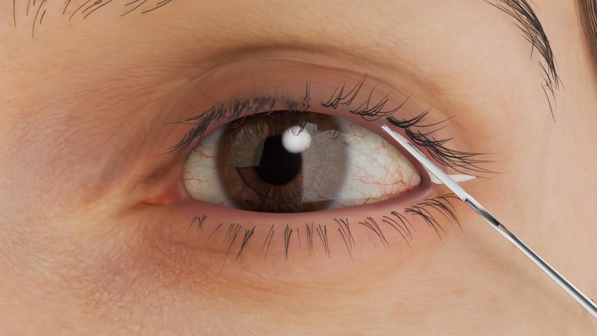 Lateral Canthoplasty – Outer Eye Corner Reshaping