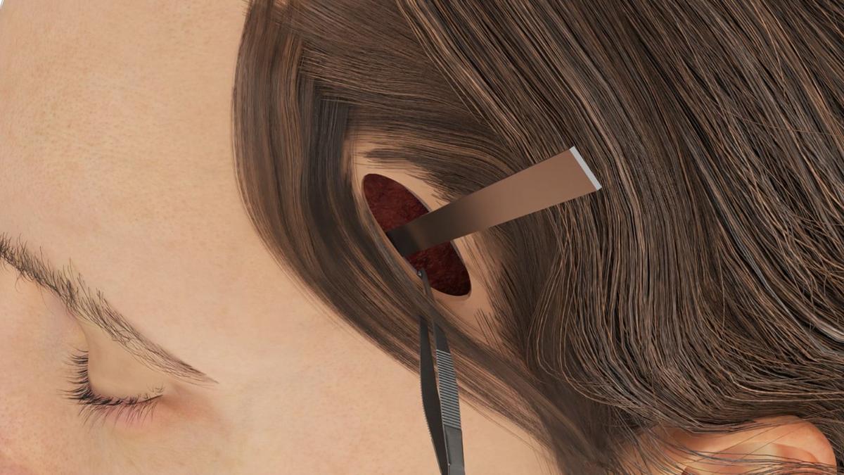 Temporal Brow Lift – Subtle Surgical Elevation