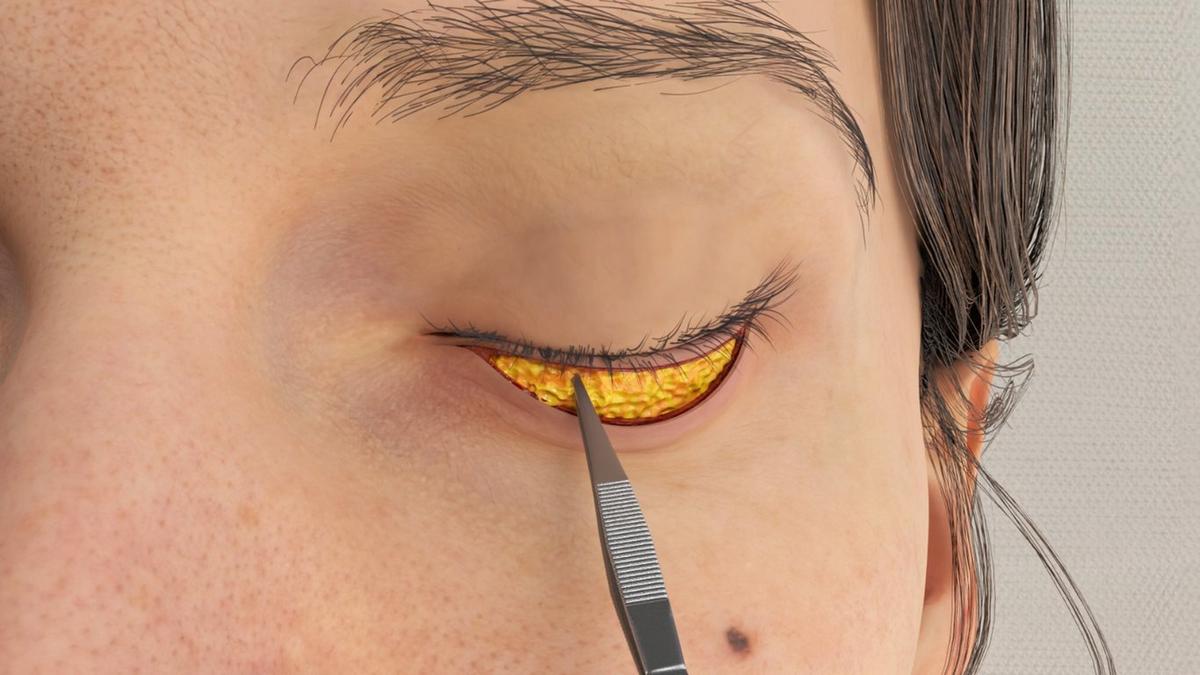 Lower Blepharoplasty – Transcutaneous Approach