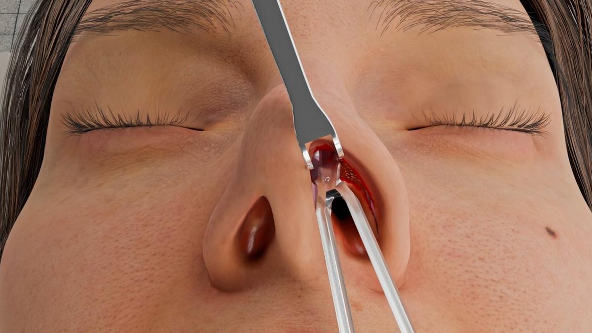 Closed Rhinoplasty (Endonasal Approach)