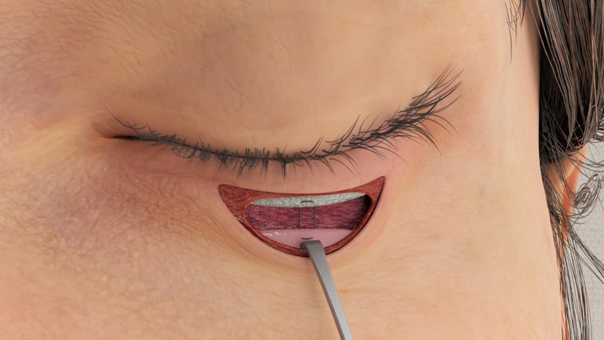 Entropion Repair - Retractor Reinsertion