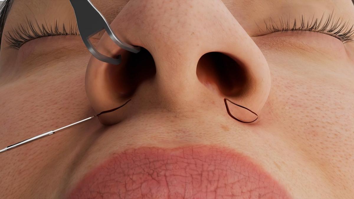 Alar Base & Nostril Reduction