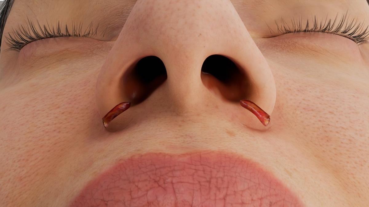Nostril Size Reduction