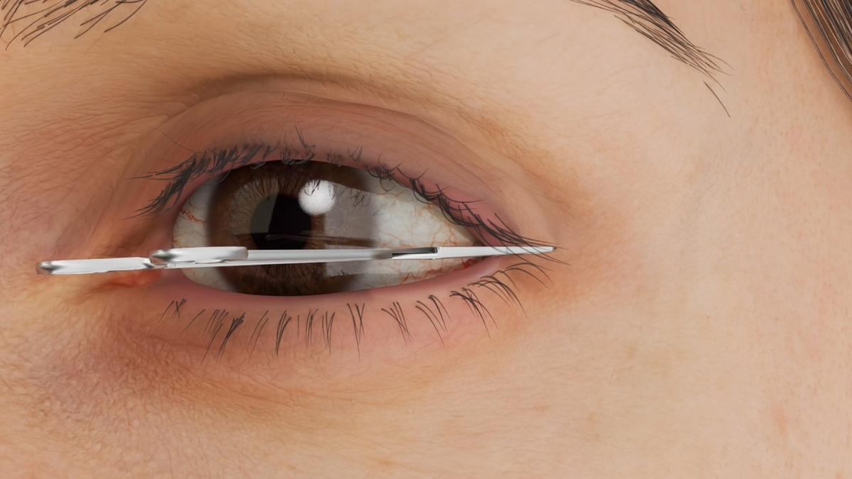 Lateral Canthopexy – Outer Eyelid Support Without Repositioning