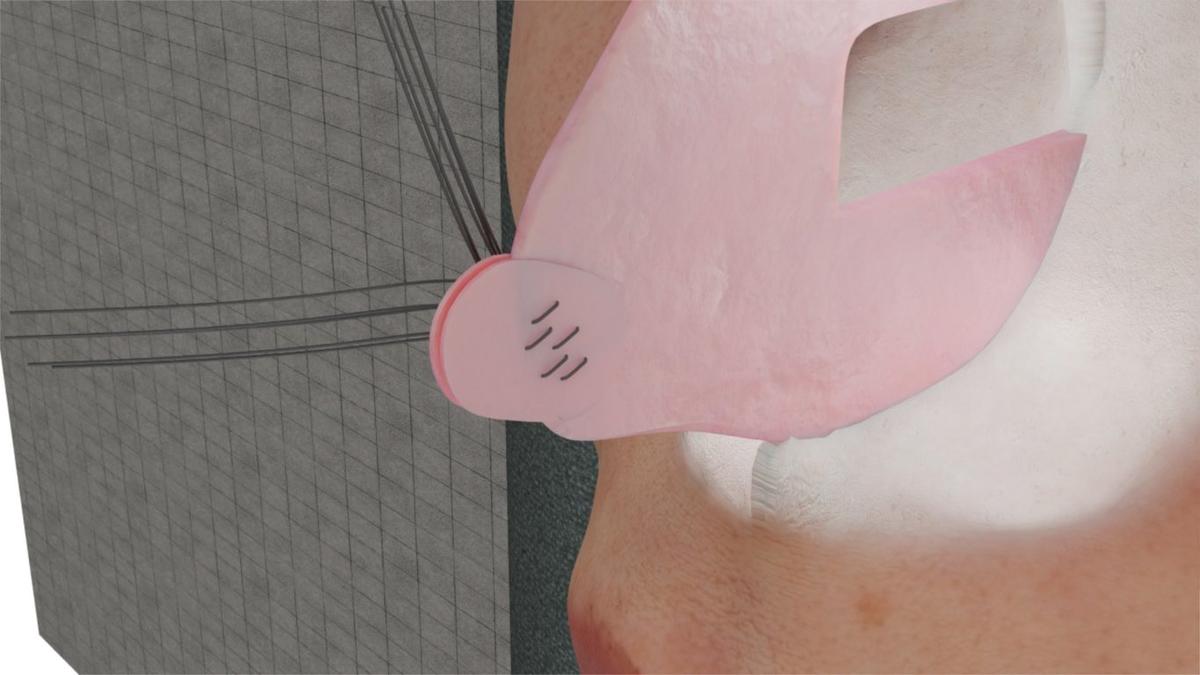 Double Septal Extension Graft