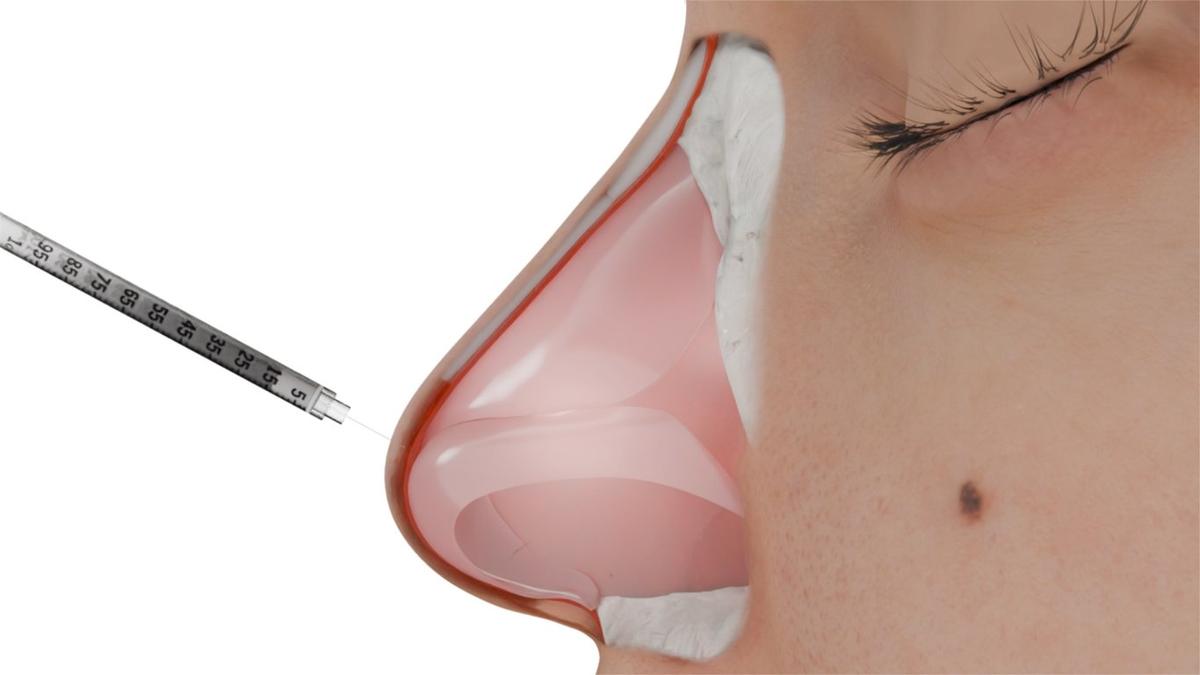 Non-Surgical Rhinoplasty (Liquid Rhinoplasty)