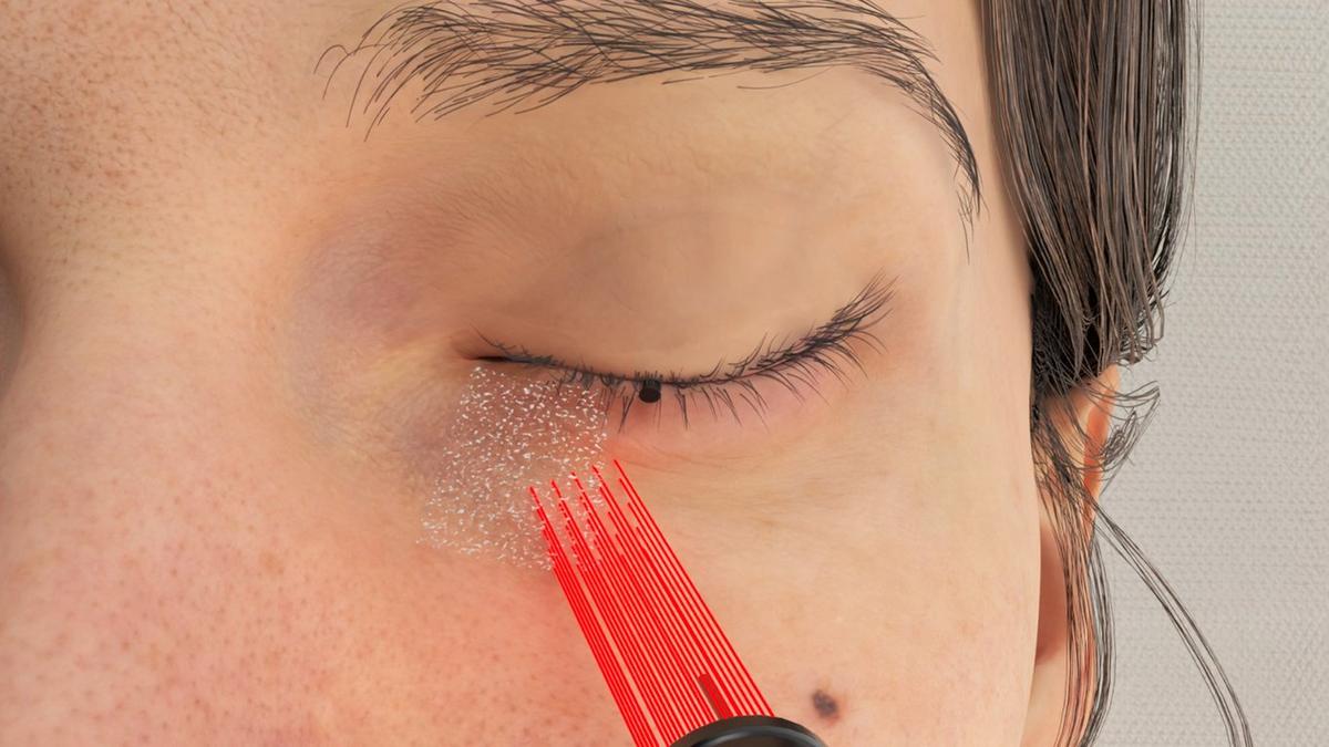 Lower Blepharoplasty – CO2 Laser Skin Tightening