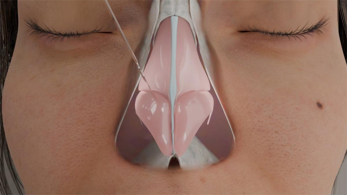 Nasal Tip Refinement