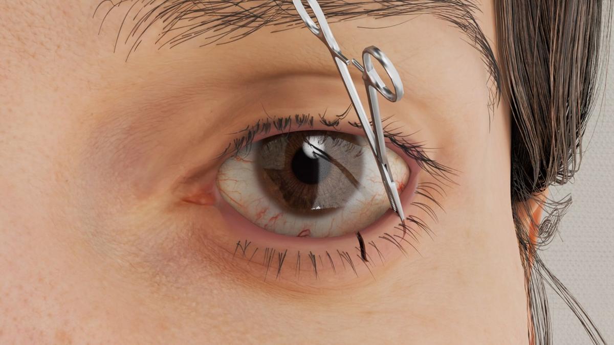 Ectropion Repair - Wedge Resection