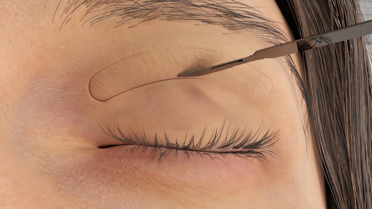Upper Blepharoplasty – Surgical Technique