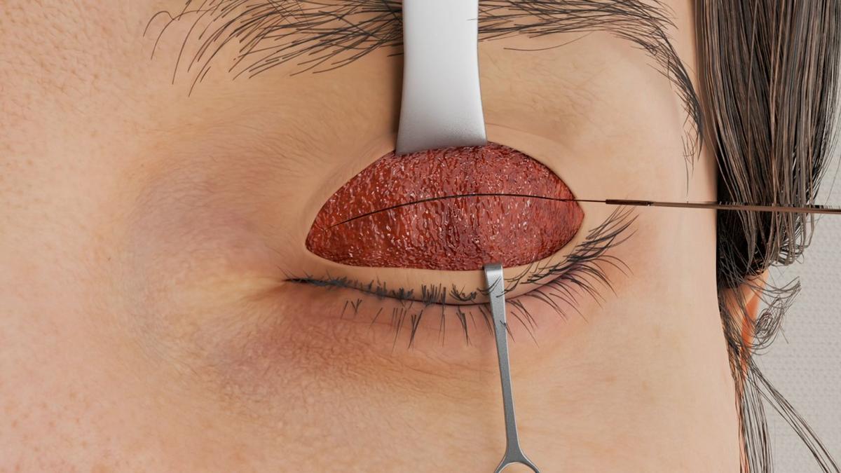 Ptosis Repair – Levator Advancement Technique