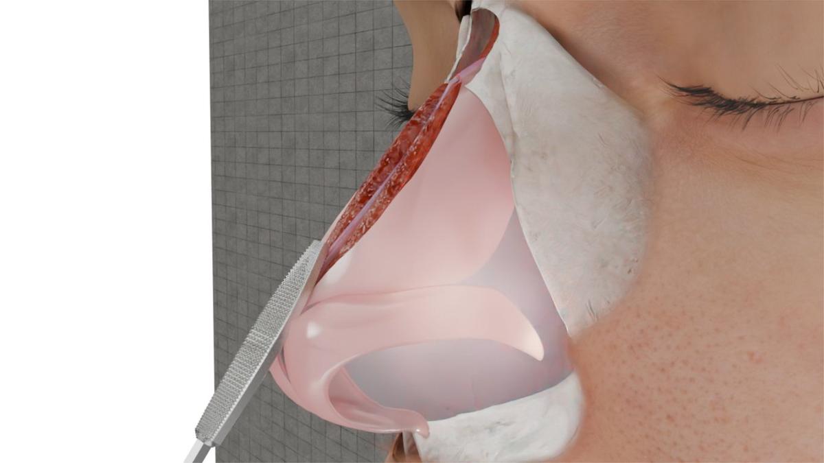 Osteotomy (Nasal Bone Cuts)