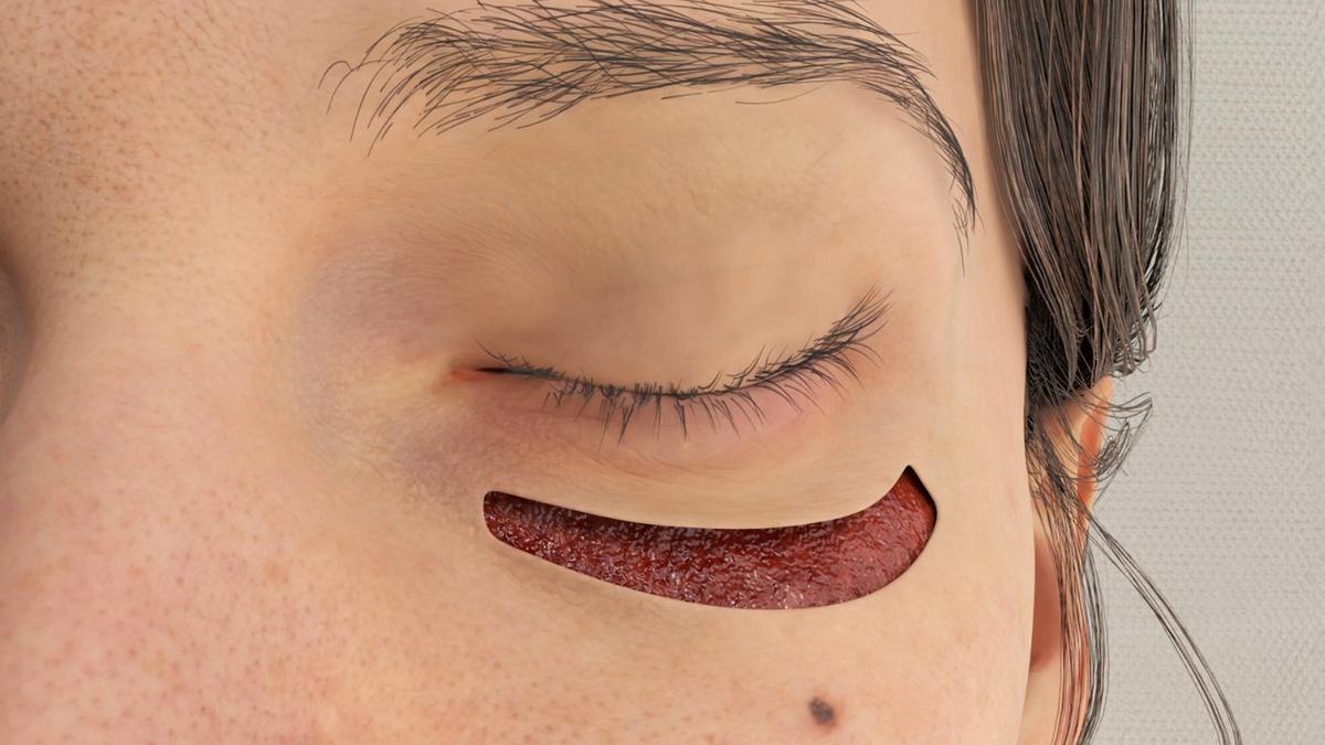 Festoons and Malar Bags – Direct Excision