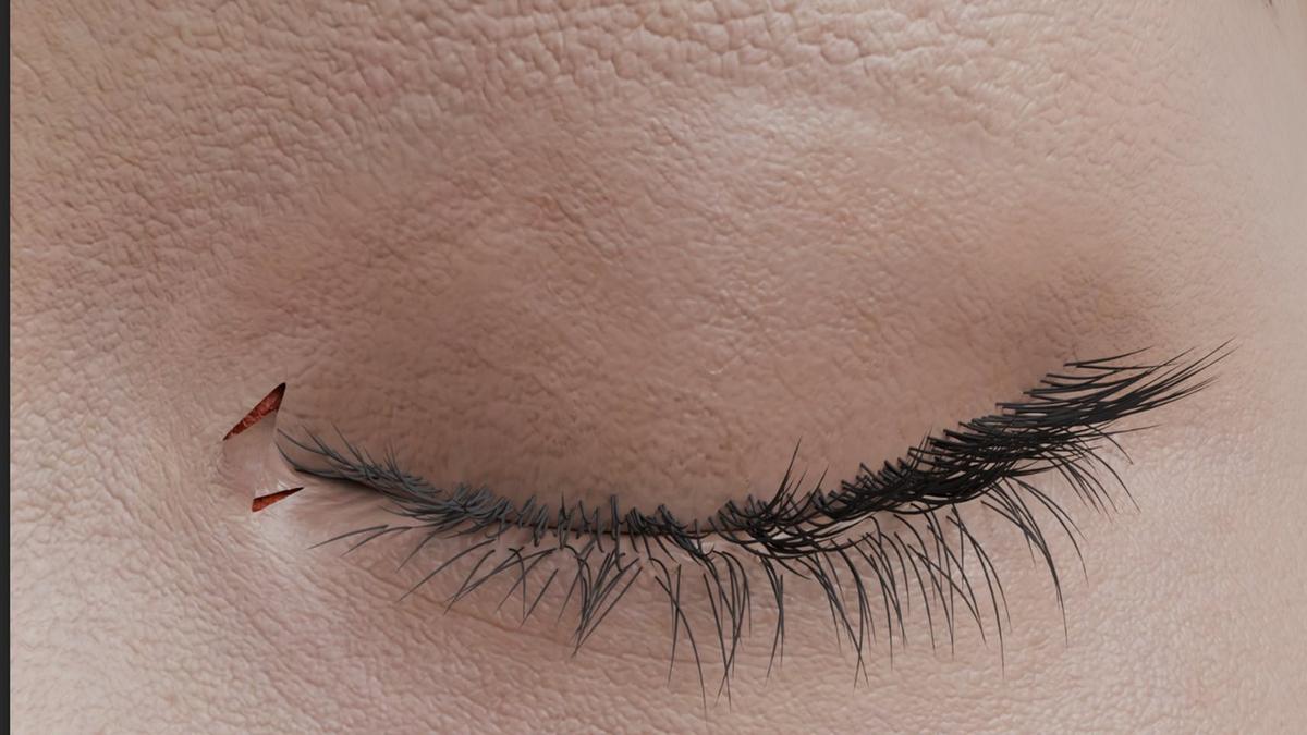 Epicanthoplasty – Inner Eye Corner Refinement