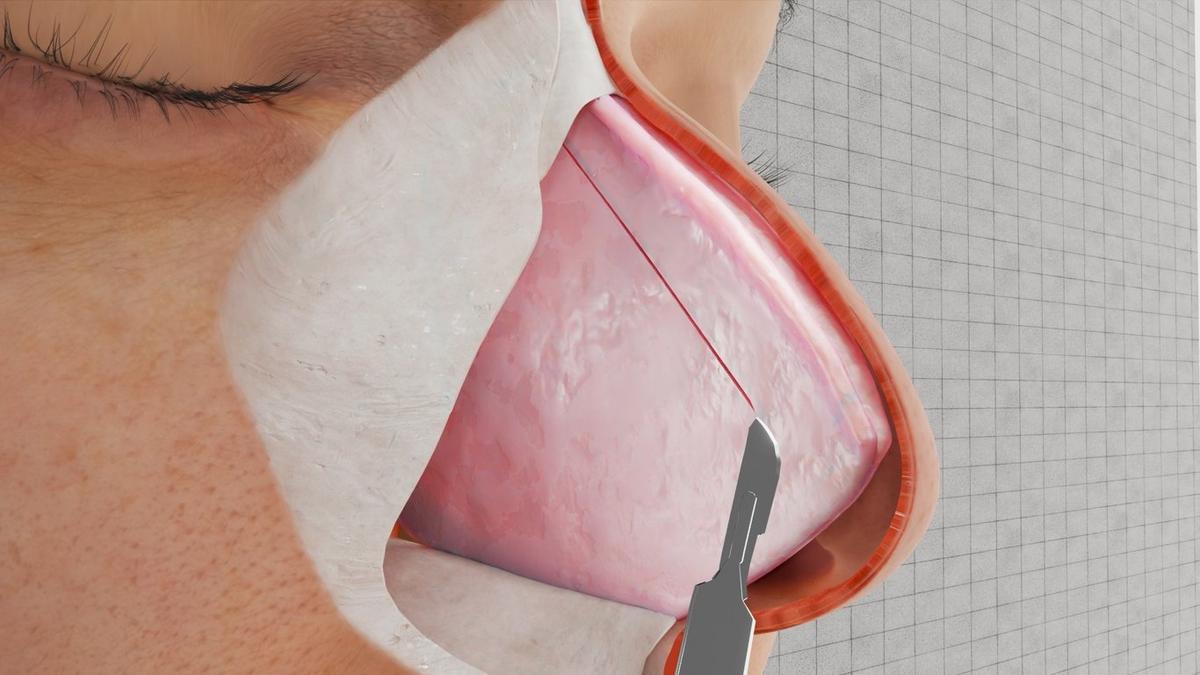 Preservation Rhinoplasty