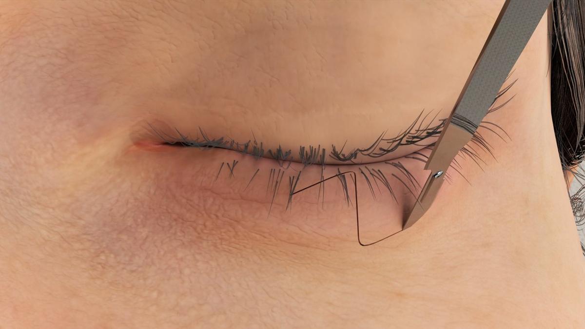 Ectropion Repair - Z-Plasty