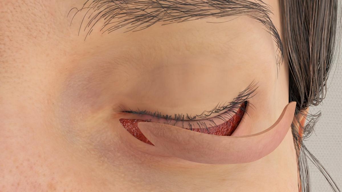 Ectropion Repair - Skin Graft