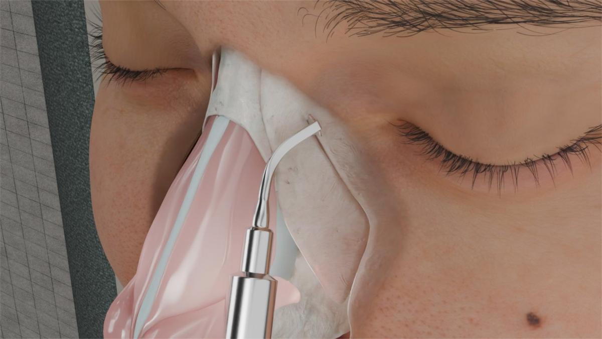 Ultrasonic Rhinoplasty (Piezo Rhinoplasty)