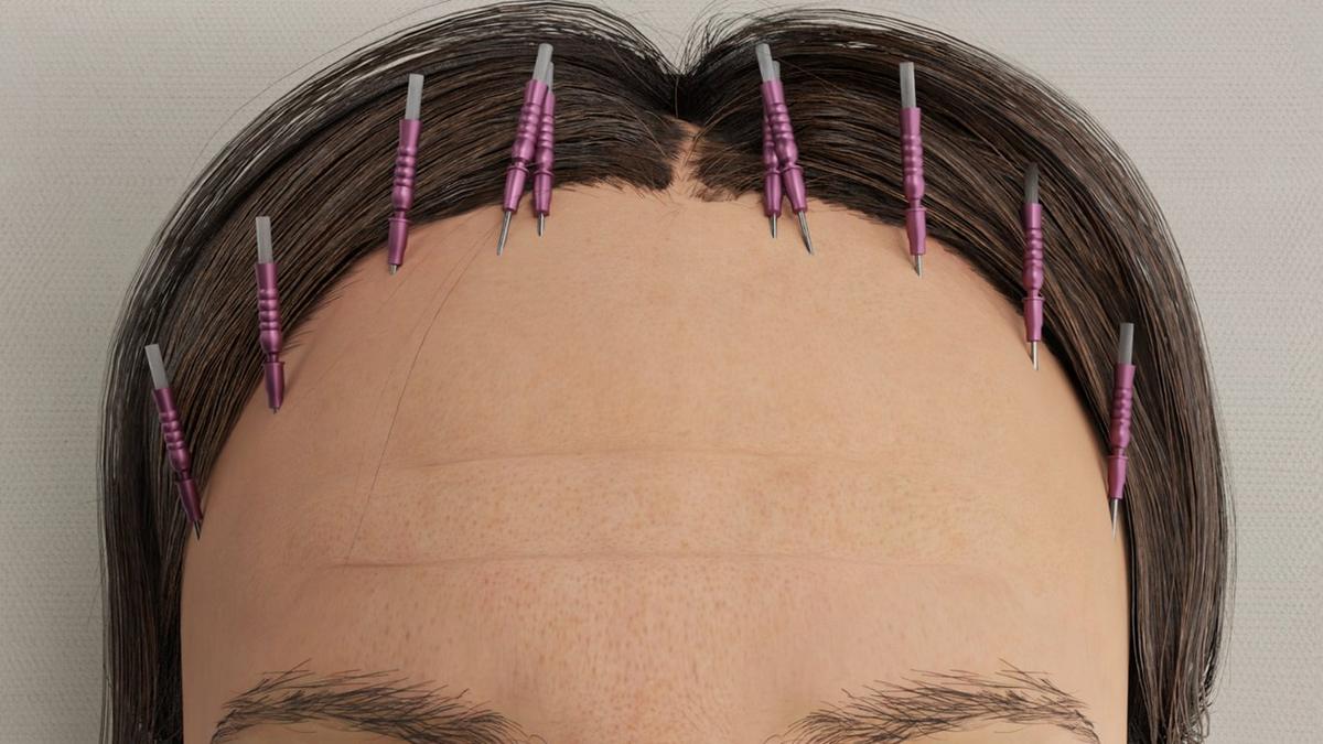 Brow Lift with Threads – Non-Surgical Elevation